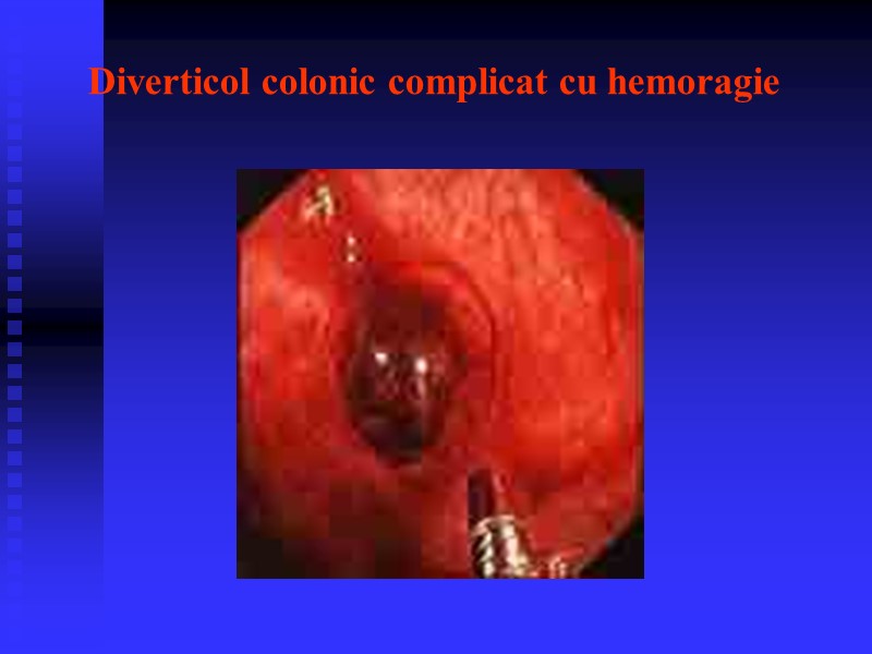 Diverticol colonic complicat cu hemoragie